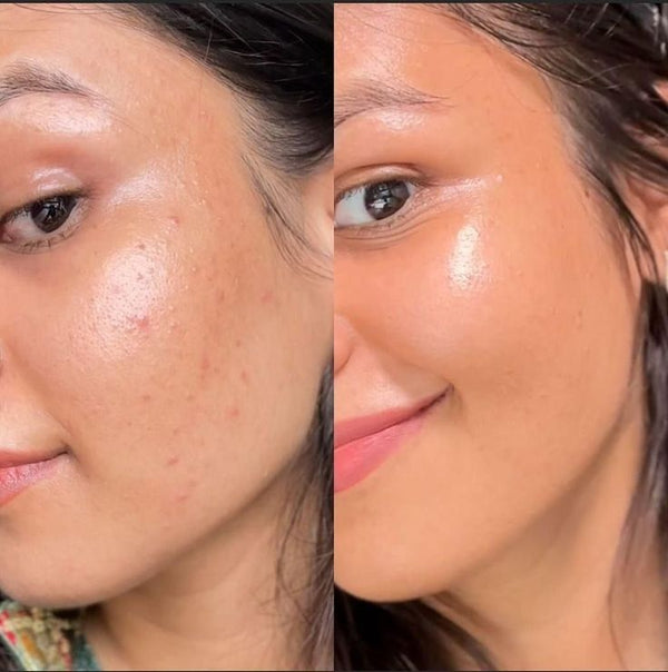 Strengthens the Skin Barrier